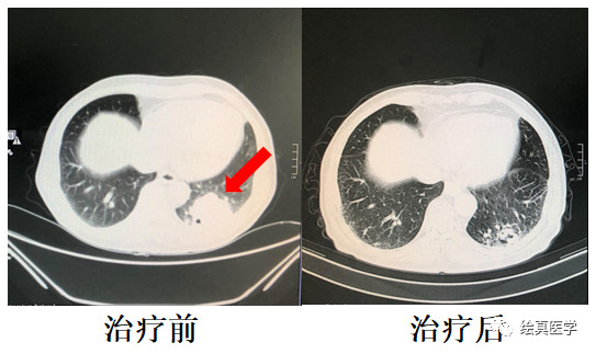 肺癌的个性化治疗